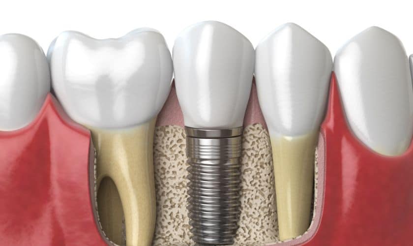 Dental Implants