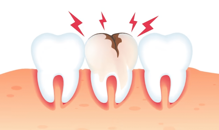Truth about Root Canals