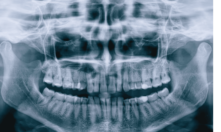 Benefits of Dental Cleanings & X-rays