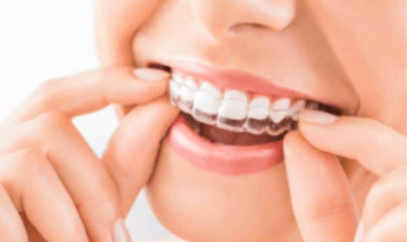 5 Benefits of Choosing Invisalign