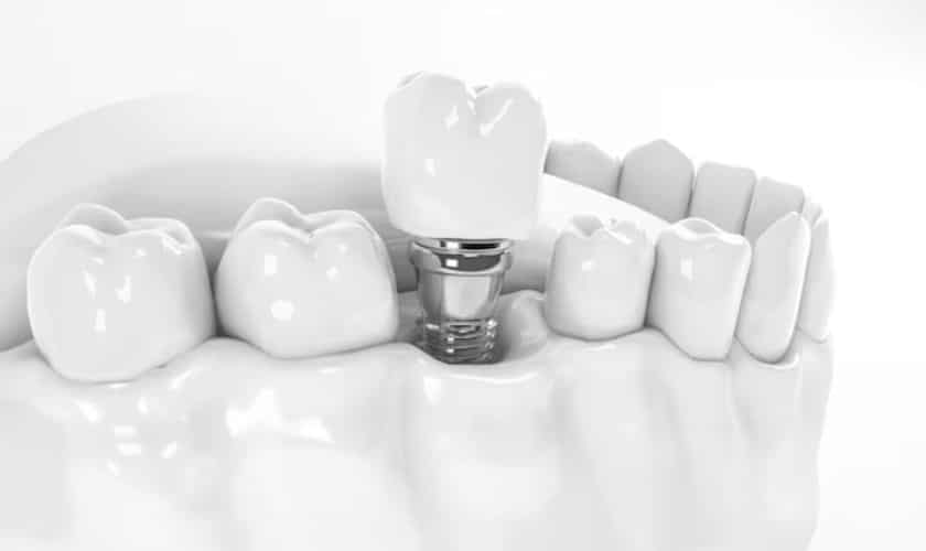 Dental Implants Grand Blanc, MI Learn About the Benefits of This
