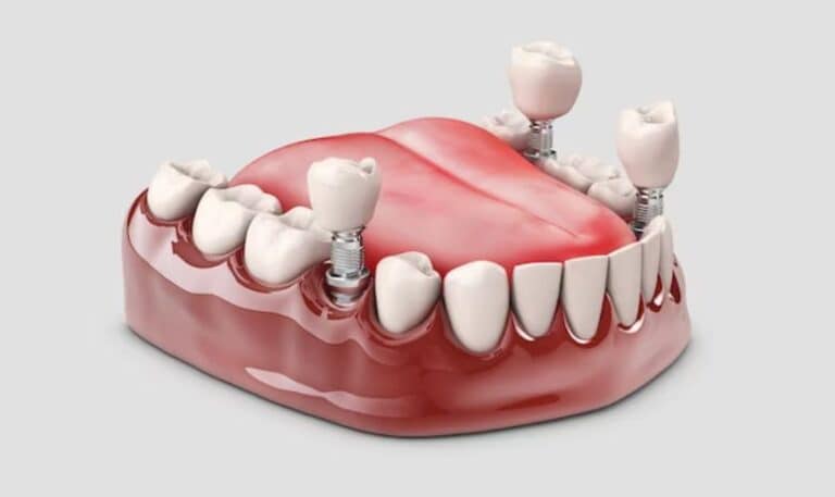 Dental Implants in Grand Blanc MI