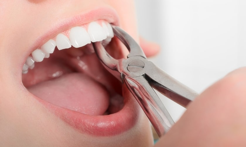 Tooth Extraction in Grand Blanc